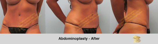 abdominal-contouring-options