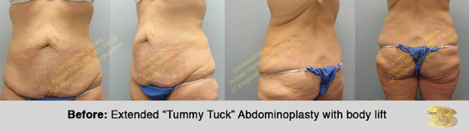 Abdominoplasty (“Tummy Tuck”) - Body Contouring - Imagine Plastic