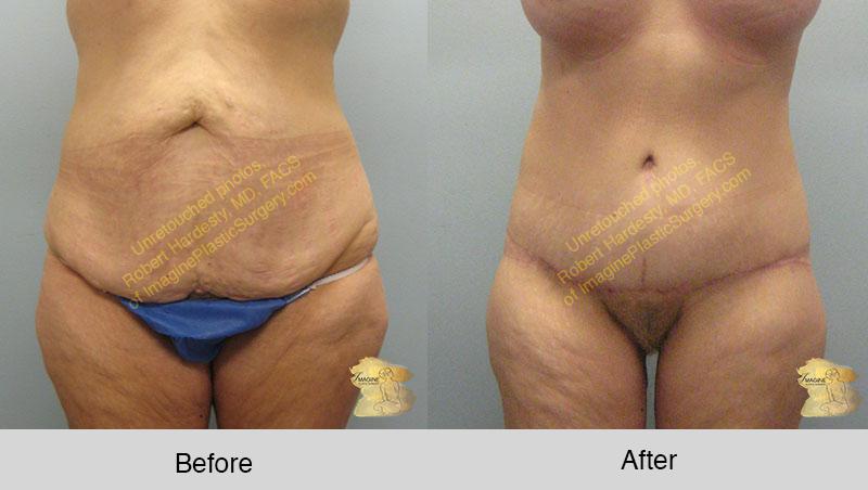 Achieving a beautiful, shapley body after weight loss or bariatric surgery  - Imagine Plastic Surgery